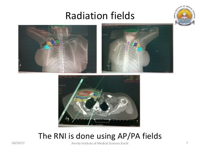 radiation electrons breast cancer Older natural nudes